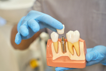 pose-implants-dentaires-dentiste-marseille-saint-tronc