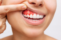 symptomes-parodontite-2-gencive-rouge-saignement-dechaussement-dentiste-marseille-st-tronc