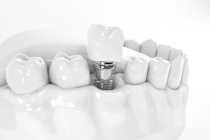 prix-implants-dentaires-dentiste-marseille-saint-tronc